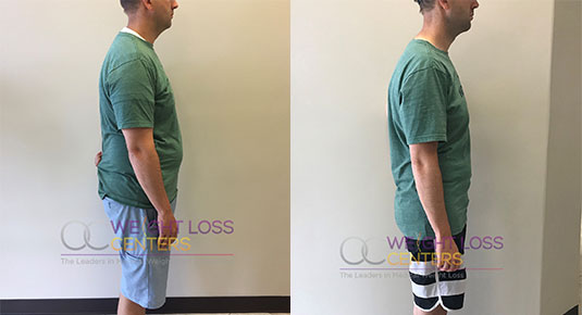 Medical weight loss before and after results
