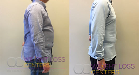 Medical weight loss transformation