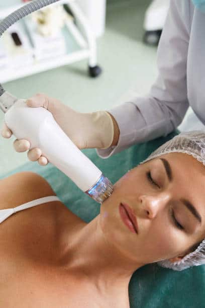 RF microneedling for facial contour